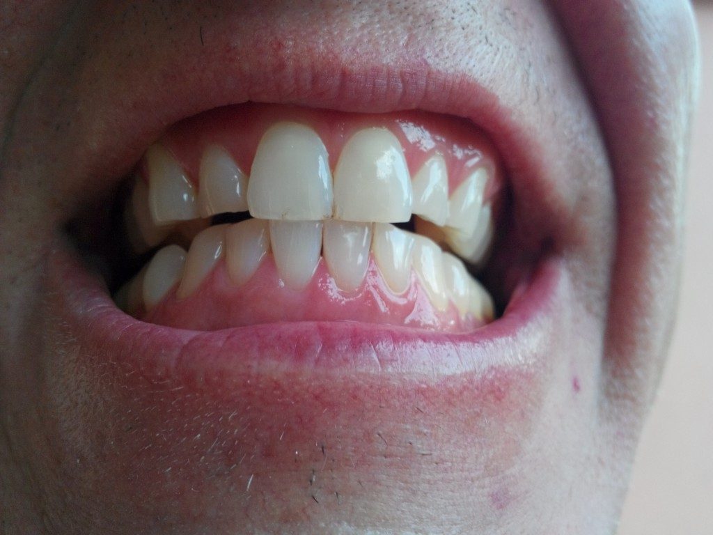 Teeth-After-1024x768